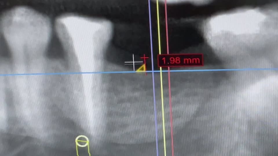 Planejamento de implante em tomografia, com medida de 1,98 mm